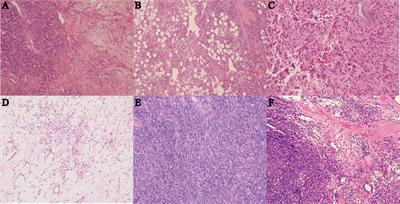 Prognostic analysis of extrameningeal solitary fibrous tumor using the modified Demicco model: a clinicopathologic study of 111 Chinese cases